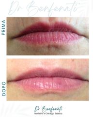 Dott. Giovanni Benfenati Trattamento delle rughe periorali