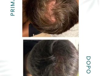 Alopecia prima e dopo - 877752