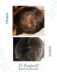 Dott. Giovanni Benfenati Ricrescita capillare con cellule staminali autologhe