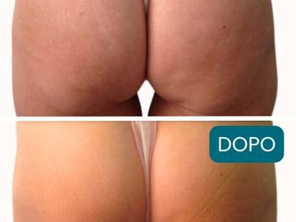 Lipo Vaser prima e dopo - 877753