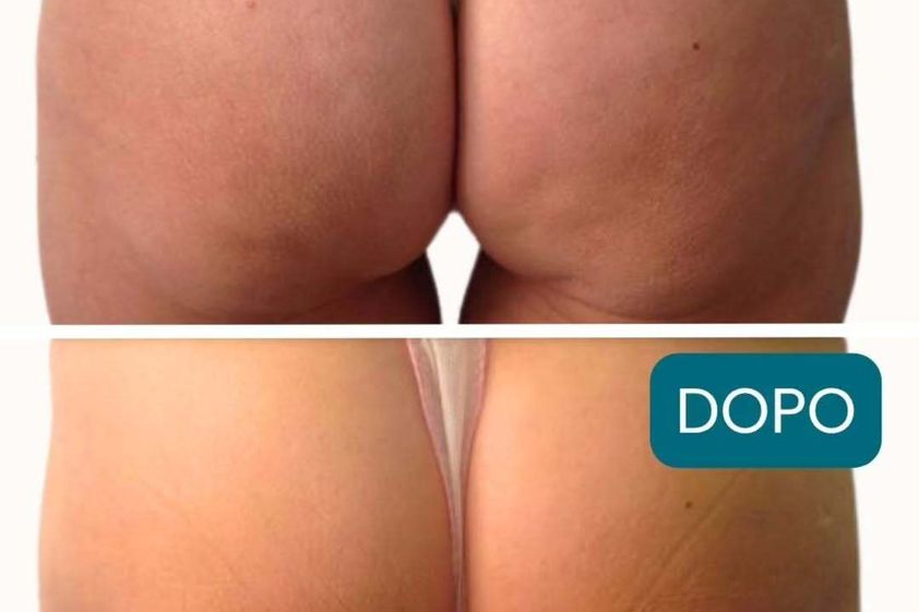 Lipo Vaser prima e dopo - 877753