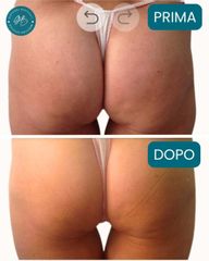 Dott. Giovanni Benfenati Vaser Lipo per il trattamento delle culotte de cheval e il rimodellamento c
