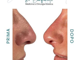 Rinofiller prima e dopo - 877754