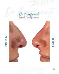 Dott. Giovanni Benfenati Rinofiller per migliorare il profilo del naso senza intervento chirurgico