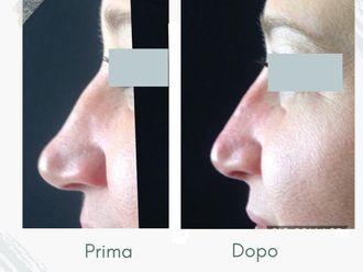 Rinofiller prima e dopo - 877755