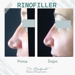 Dott. Giovanni Benfenati Rinofiller per correggere la gobbetta e armonizzare il profilo del naso