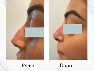 Rinofiller prima e dopo - 877756