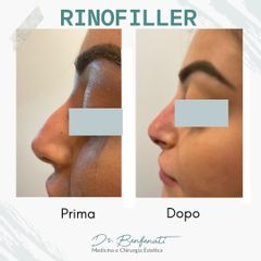 Dott. Giovanni Benfenati Rinofiller per un profilo nasale più armonioso