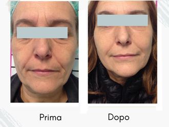 Lipofilling prima e dopo - 877757