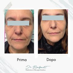 Dott. Giovanni Benfenati Lipofilling del viso per il ripristino naturale dei volumi