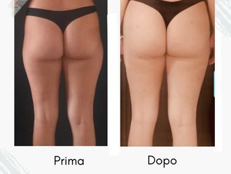 Liposcultura prima e dopo - 877758