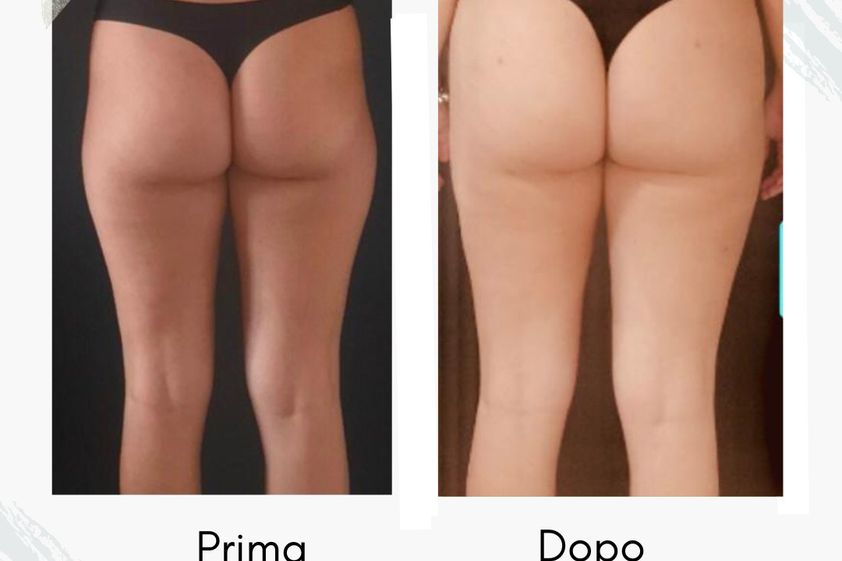 Liposcultura prima e dopo - 877758