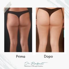 Dott. Giovanni Benfenati Liposcultura con lipofilling per ridefinire il profilo dei glutei