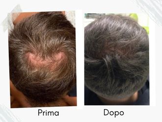 Alopecia prima e dopo - 877759