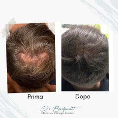 Dott. Giovanni Benfenati Trattamento per il diradamento dei capelli con Tricopat e mesoterapia