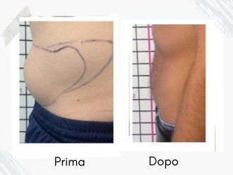 Intralipoterapia prima e dopo - 877760