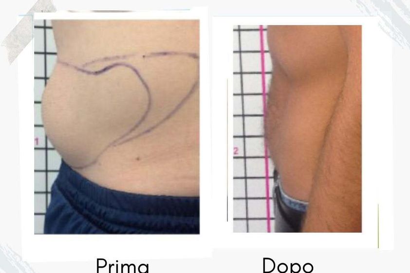 Intralipoterapia prima e dopo - 877760