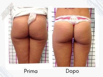 Liposcultura prima e dopo - 877761