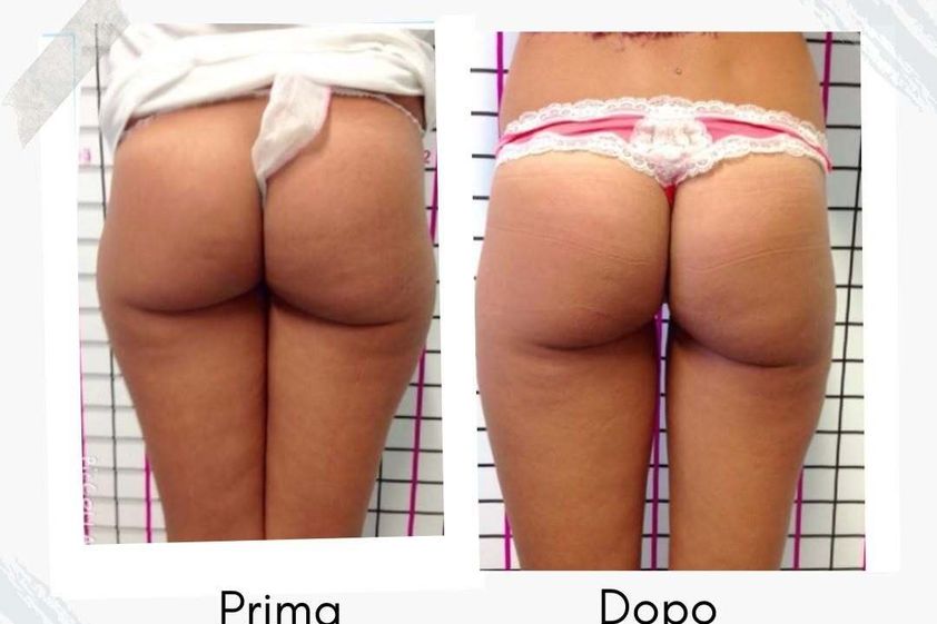 Liposcultura prima e dopo - 877761