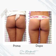 Dott. Giovanni Benfenati Mini liposcultura ambulatoriale per il rimodellamento del profilo corporeo