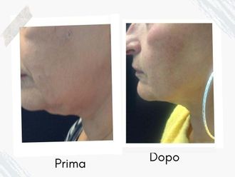 Ringiovanimento prima e dopo - 877762