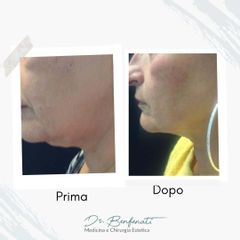 Dott. Giovanni Benfenati Endolift laser per il rassodamento di viso e collo