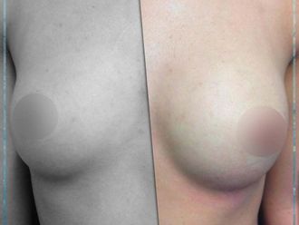 Lipofilling prima e dopo - 877763