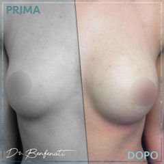Dott. Giovanni Benfenati Lipofilling del seno prima e dopo per un aumento naturale dei volumi