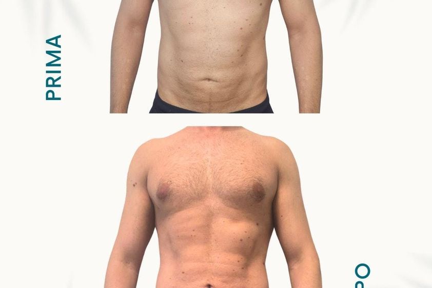 Liposcultura prima e dopo - 878198