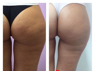 Cellulite prima e dopo