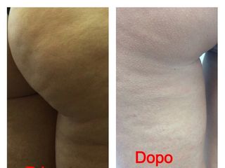 Cellulite prima e dopo