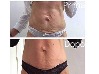 Radiofrequenza prima e dopo