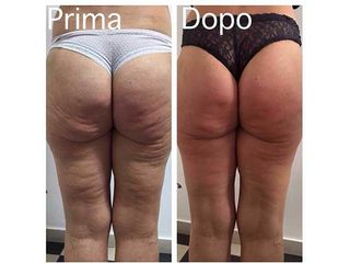 Radiofrequenza prima e dopo