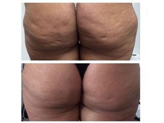 Cellulite prima e dopo