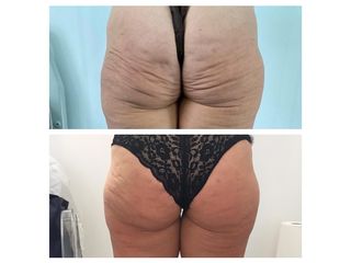 Endolift prima e dopo