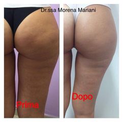 Cellulite prima e dopo - Dott.ssa Morena Mariani