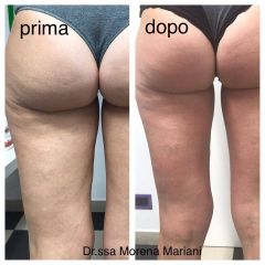 Cellulite prima e dopo - Dott.ssa Morena Mariani