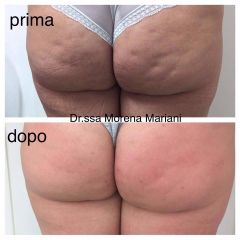 Cellulite prima e dopo - Dott.ssa Morena Mariani