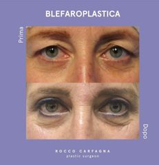 Blefaroplastica - Dott.ssa Morena Mariani