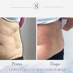 Cellulite - Osteo Lab srl