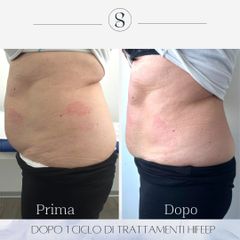 Cellulite - Osteo Lab srl