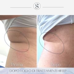 HIFU - Osteo Lab srl