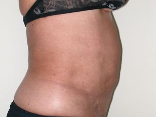 Liposuzione addome e fianchi dopo