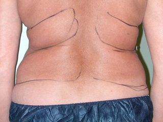 Liposuzione addome e fianchi prima