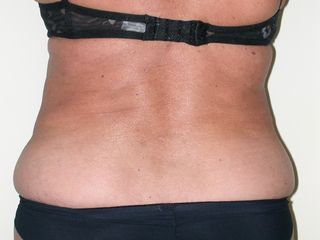 Liposuzione addome e fianchi dopo