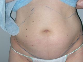 Liposuzione addome e fianchi prima