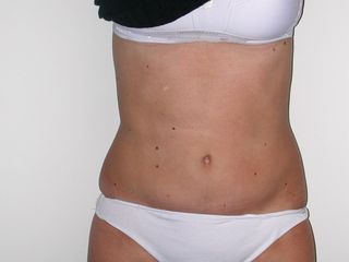 Liposuzione addome e fianchi dopo