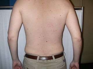 Liposuzione addome e fianchi dopo