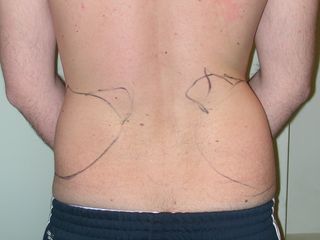Fianchi prima di liposuzione