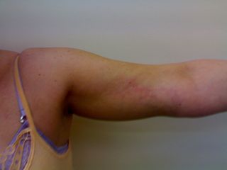 Liposuzione braccia dopo